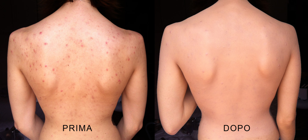 Come Fare Per Combattere L Acne Sulla Schiena Thegiornale