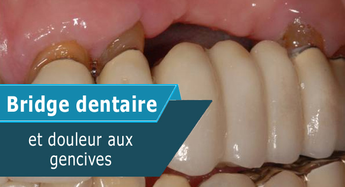 Bridge Dentaire Et Douleur Aux Gencives