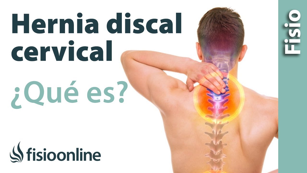 Hernia Discal Cervical Que Es Y Cuales Son Sus Causas Fisioonline 8210