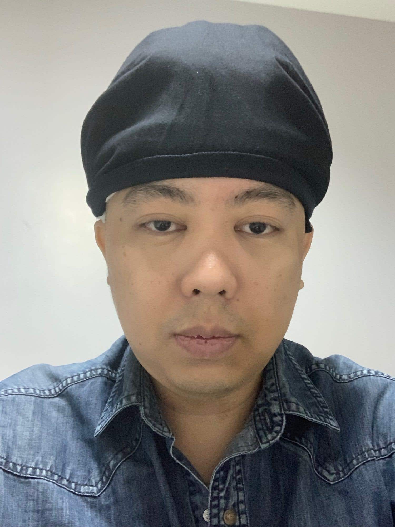 รีวิวการปลูกผม กับเรื่องราว ณ วันผ่าตัด 16 ปลูกผม - รีวิวการปลูกผม กับเรื่องราว ณ วันผ่าตัด