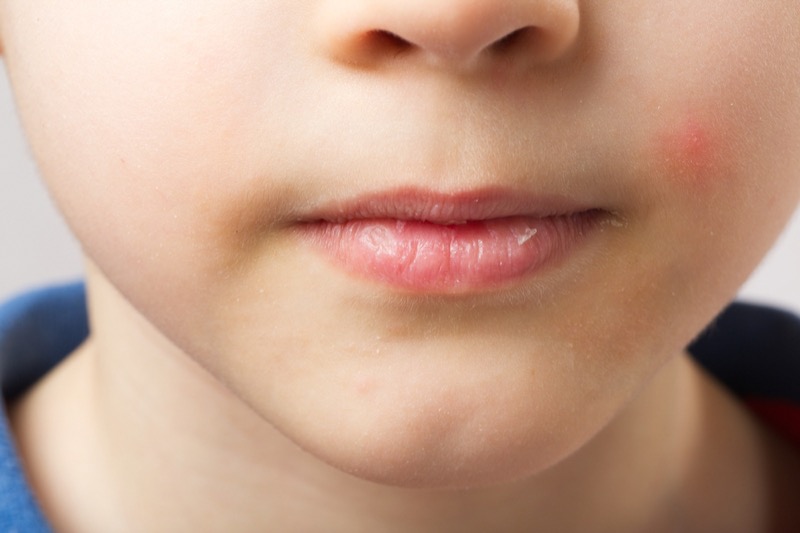 Aaa Cercasi Rimedi Dermatite Atopica Che Cos E I Miei Consigli E I Prodotti Make Up Giusti