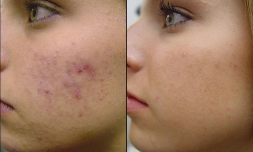 Il Rimedio Definitivo Contro L Acne E L Inositolo Cos E E Come Usarlo Al Meglio