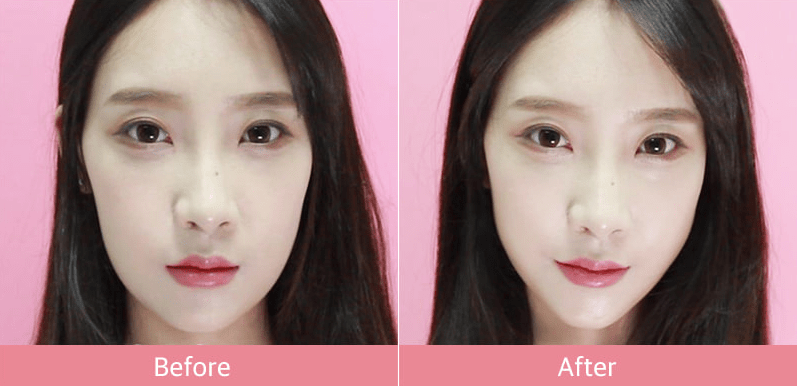 Come Snellire Il Viso Senza Bisturi Con I Cerotti Effetto Lifting Made In Corea