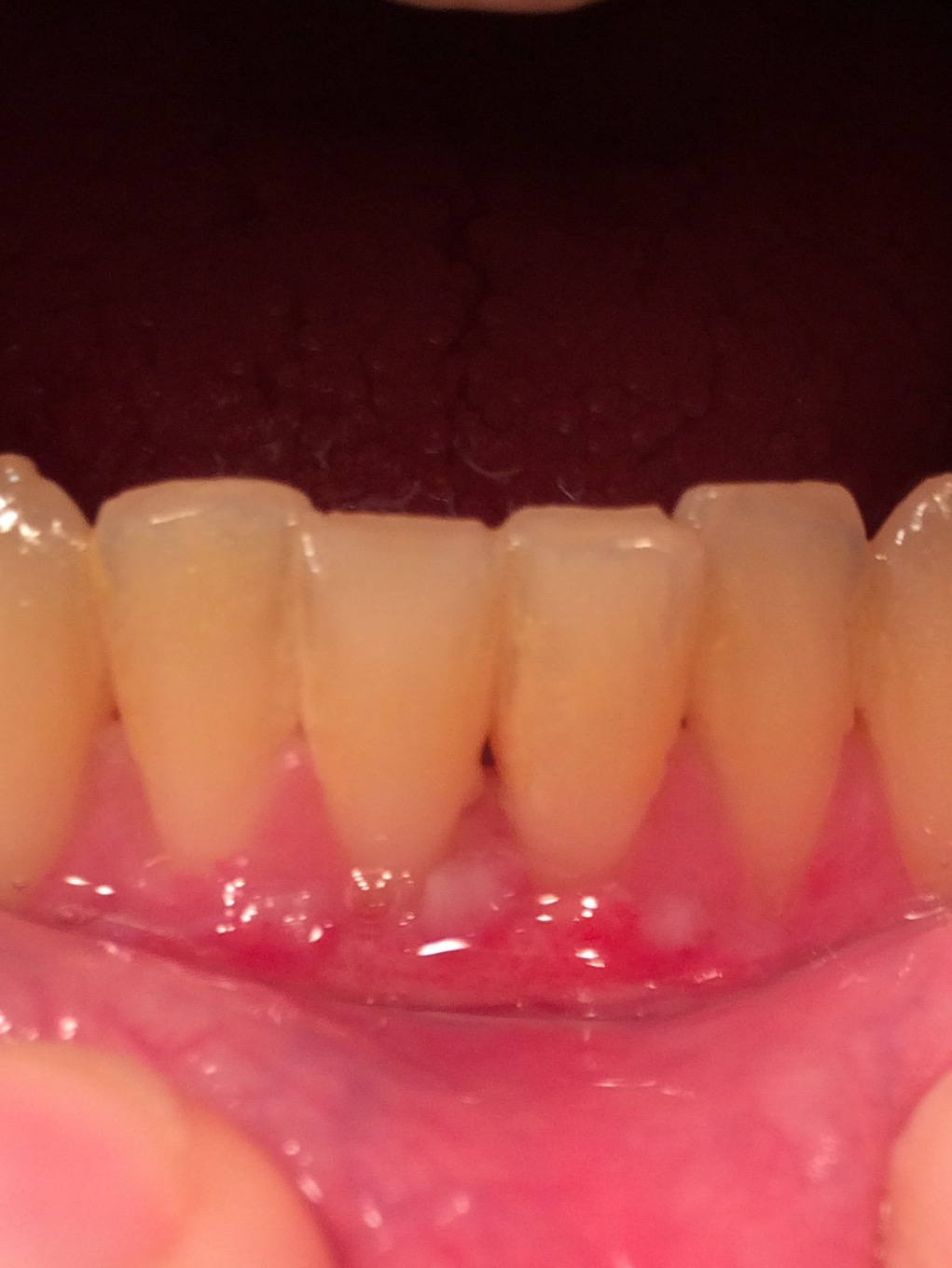 Greffe De Gencive Suites Post Operatoires Conseil Dentaire Dr Hauteville