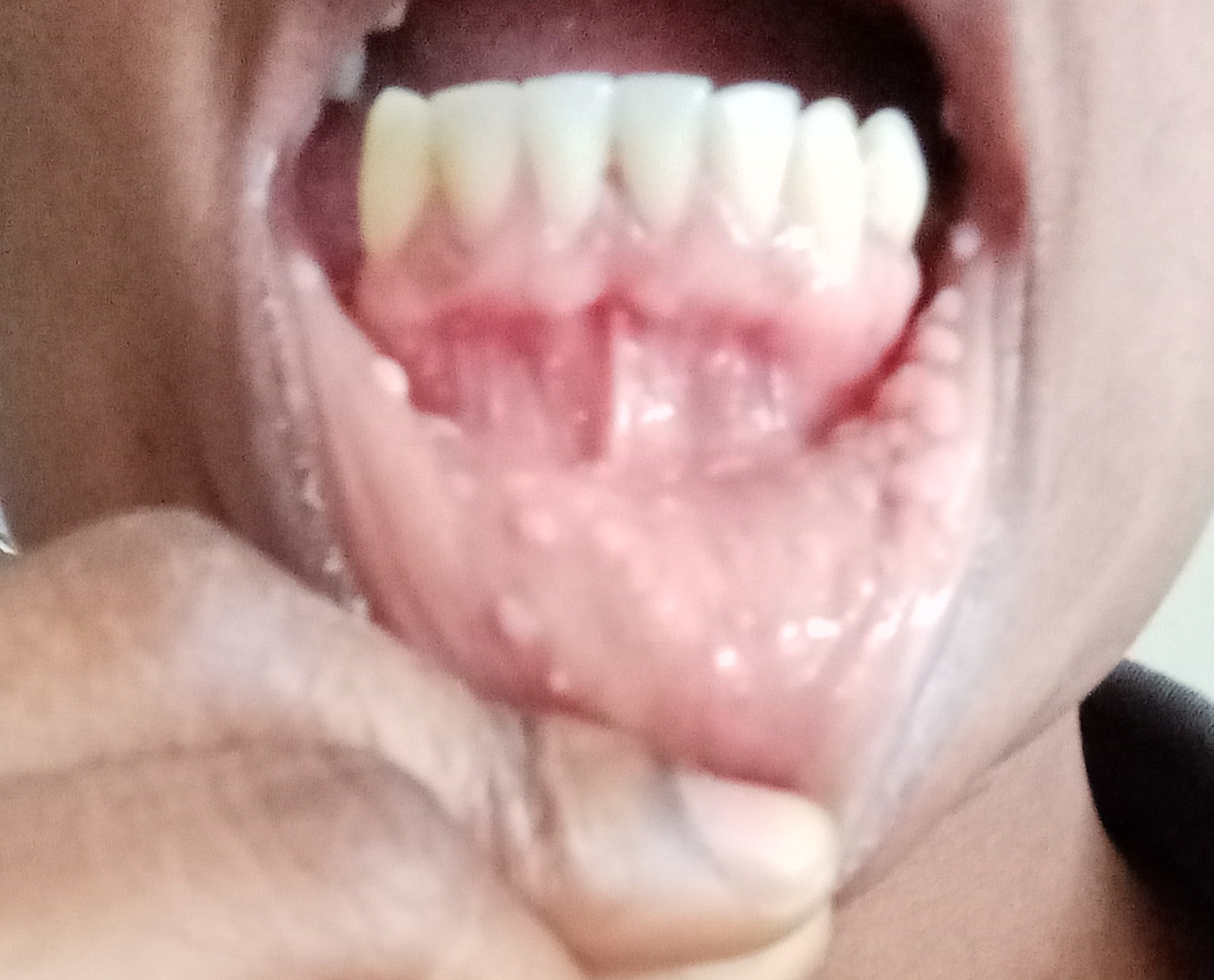 Maladie De Heck Conseil Dentaire Dr Hauteville