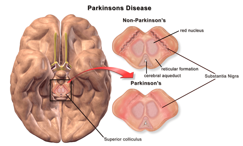 Difference Between MS and Parkinson’s 