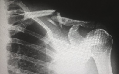 Deciding If Hurt Or Injured Collar Bone