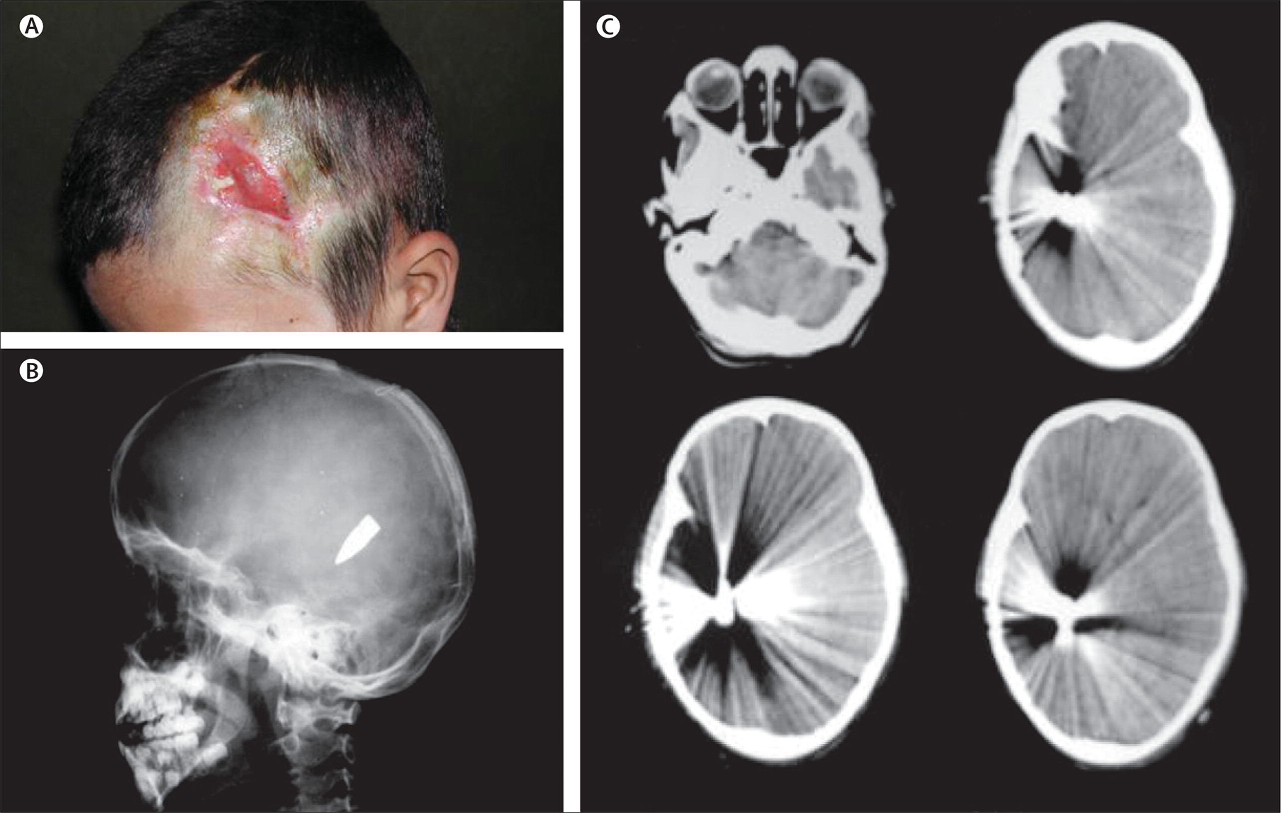 Bala perdida alojada en el cerebro de un niño de 10 años dos meses después. Fuente.