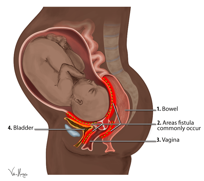 key difference between fistula and fissure