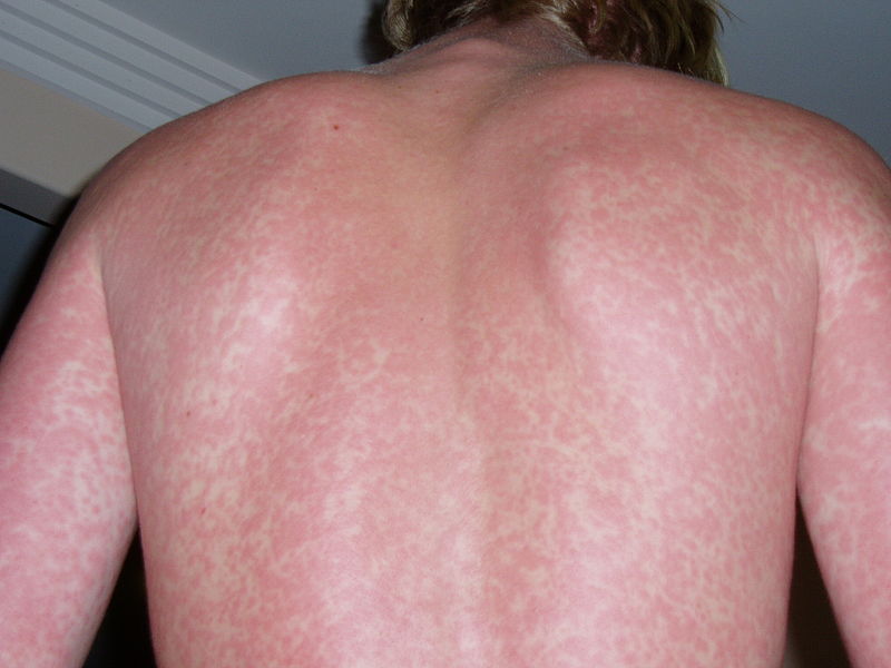  main difference - hives vs rash