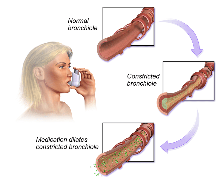 Difference Between Bronchospasms and Laryngospasms