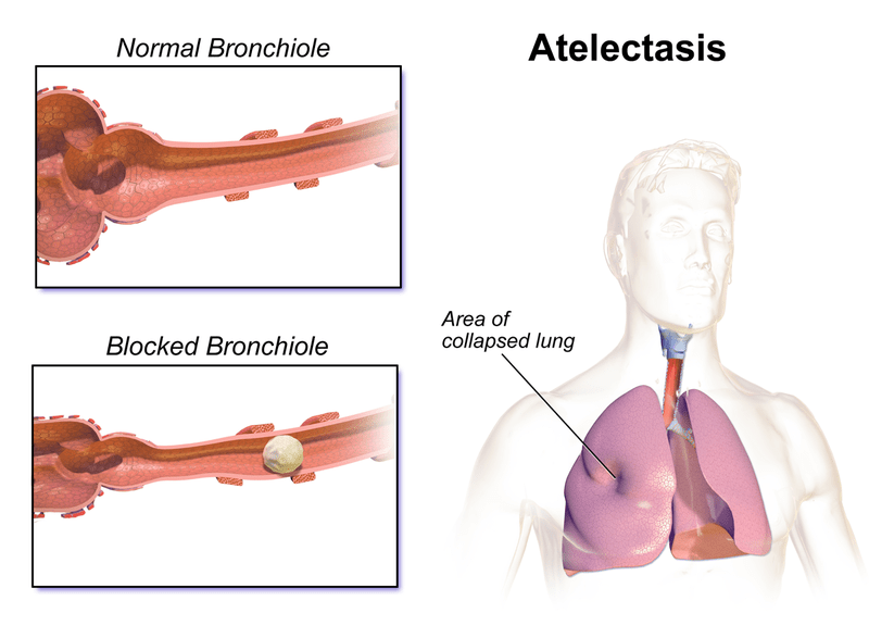 Difference Between RSV and Bronchiolitis