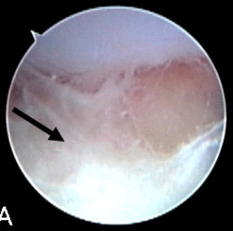 Key Difference - Osteomyelitis vs Septic Arthritis 