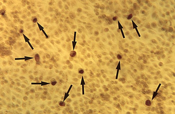 Difference Between Chlamydia and Thrush 