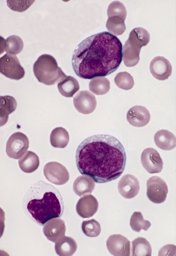 Difference Between Myeloblast and Lymphoblast 