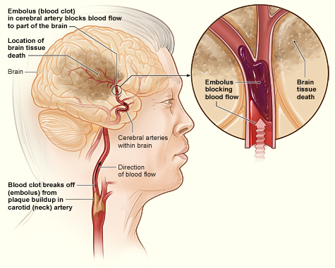 Difference Between Ischemic and Hemorrhagic Stroke