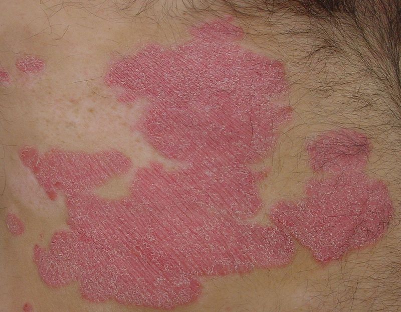 Key Difference Between Plaque Psoriasis and Psoriasis 