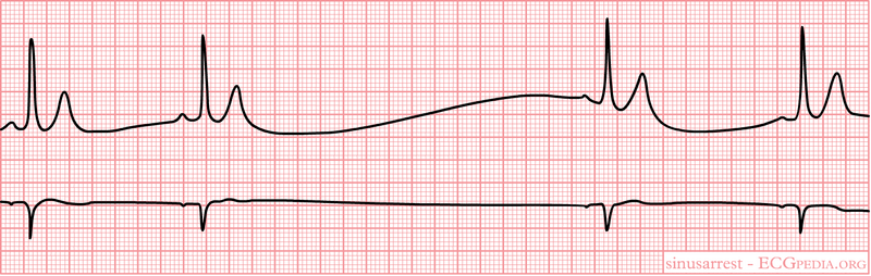 Difference Between Sinus Arrest and Sinus Block