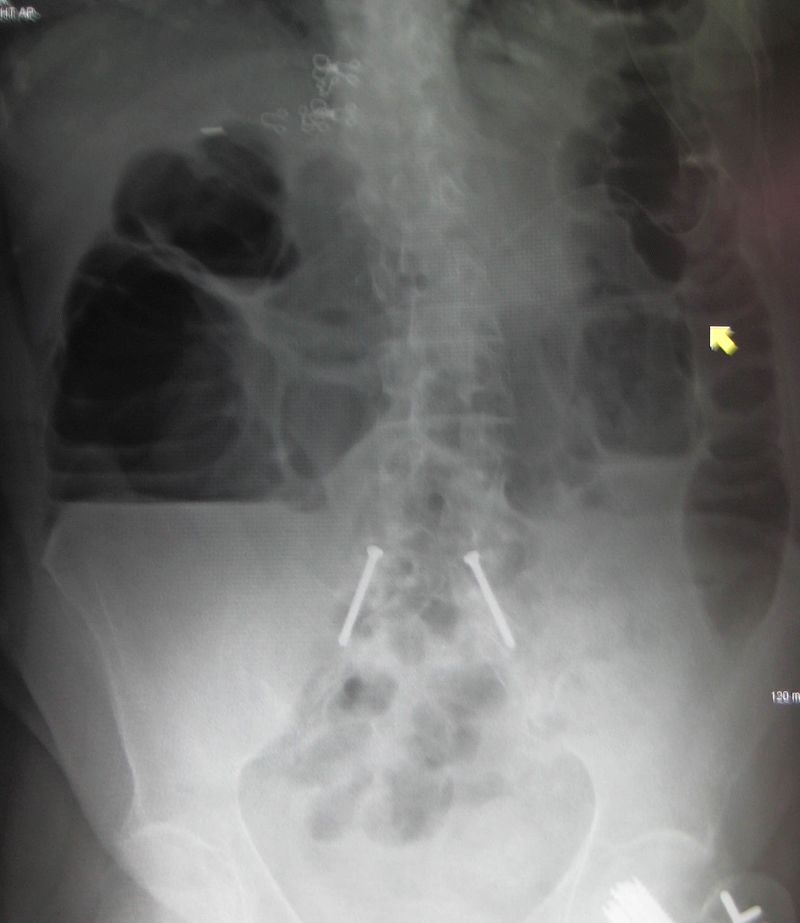 Key Difference Between Small and Large Bowel Obstruction