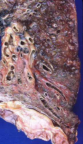 Key Difference Between Interstitial Lung Disease and Bronchiectasis