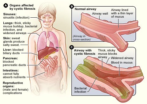 Difference Between Genetic Disorders and Chromosomal Disorders