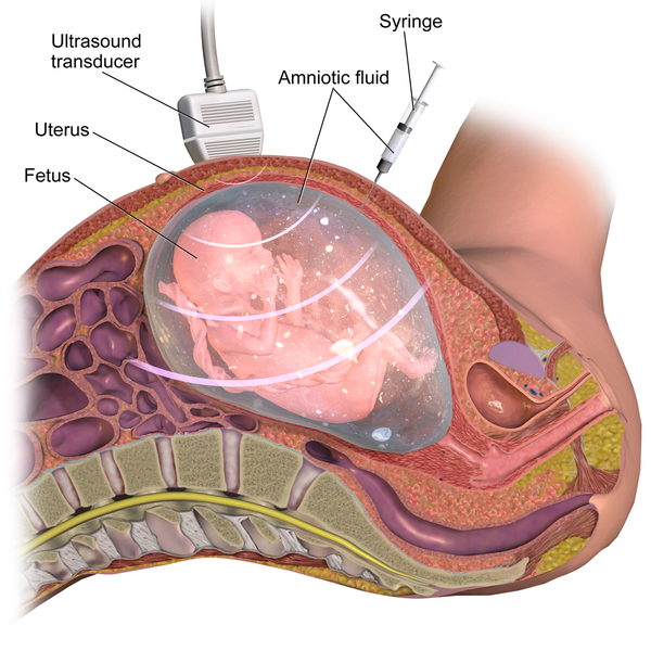 Difference Between Amniocentesis and Cordocentesis