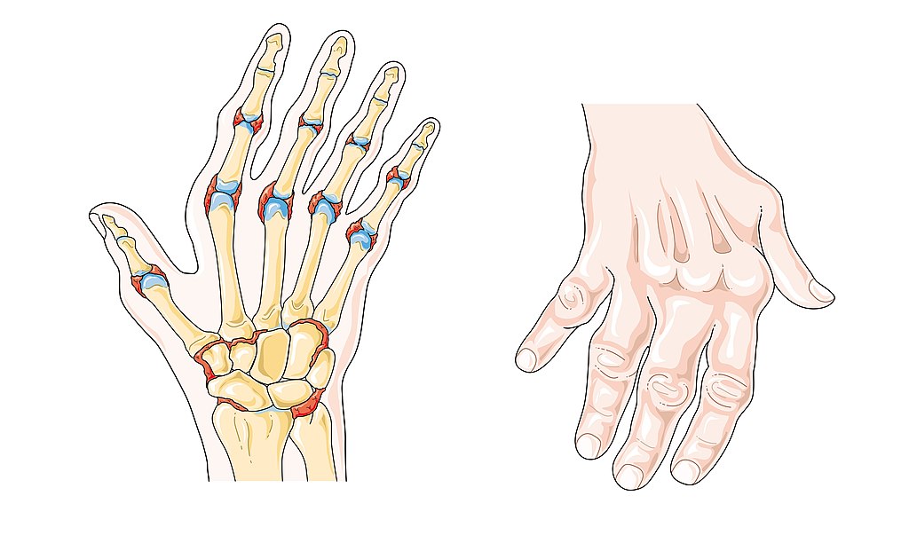 Juvenile Idiopathic Arthritis vs Rheumatoid Arthritis in Tabular Form