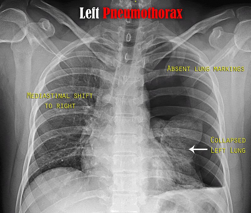 Pneumothorax and Tension Pneumothorax - Side by Side Comparison 