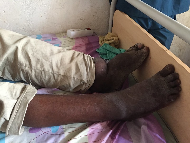 Filariasis and Elephantiasis - Side by Side Comparison 