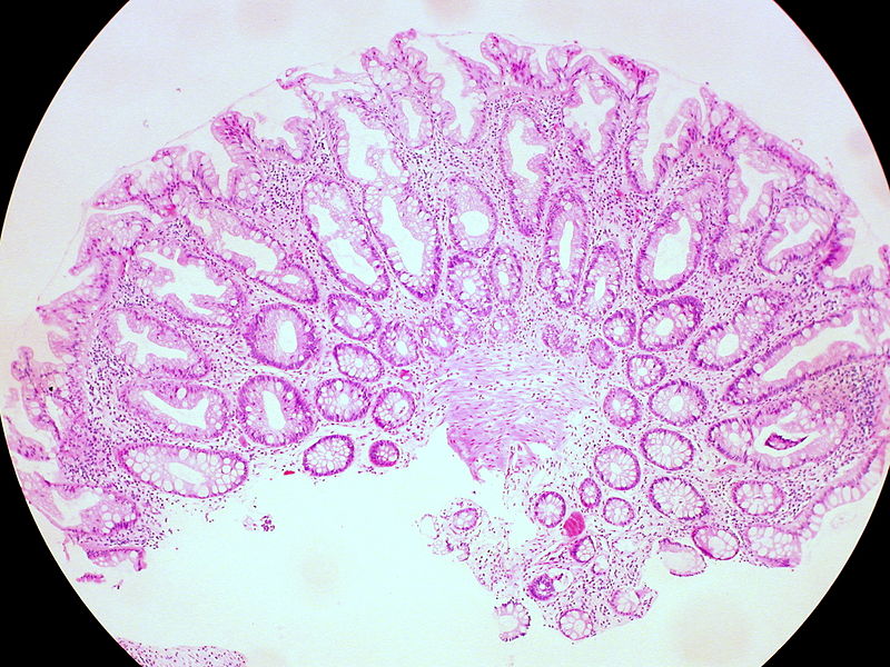 Adenoma and Polyp - Side by Side Comparison 