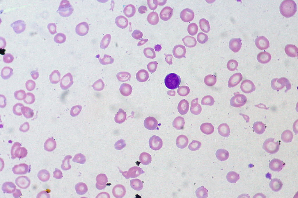 Hemolytic Anemia and Iron Deficiency Anemia - Side by Side Comparison 