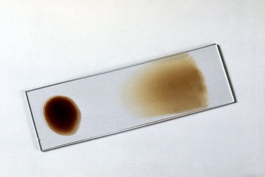 Thin vs Thick Smear in Tabular Form