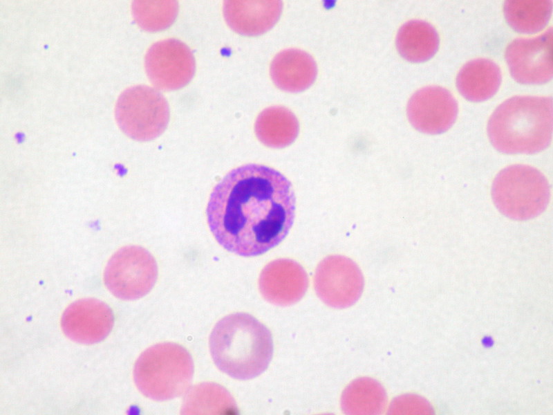 Hemolytic Anemia vs Iron Deficiency Anemia in Tabular Form