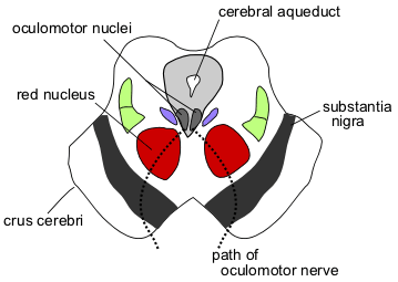 Communicating and Noncommunicating Hydrocephalus - Side by Side Comparison 