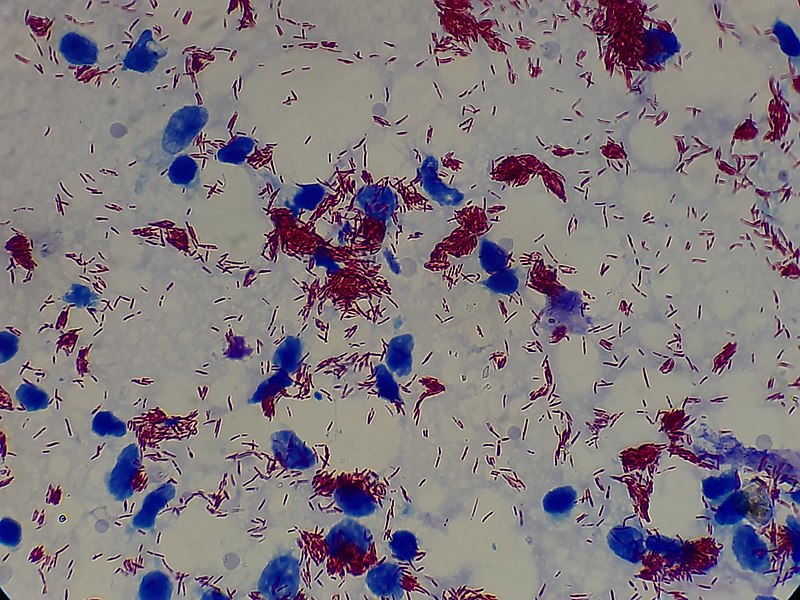 Mycobacterium Tuberculosis and Mycobacterium Leprae - Side by Side Comparison 