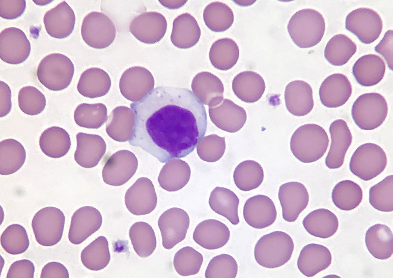 B Cell vs T Cell Leukemia in Tabular Form