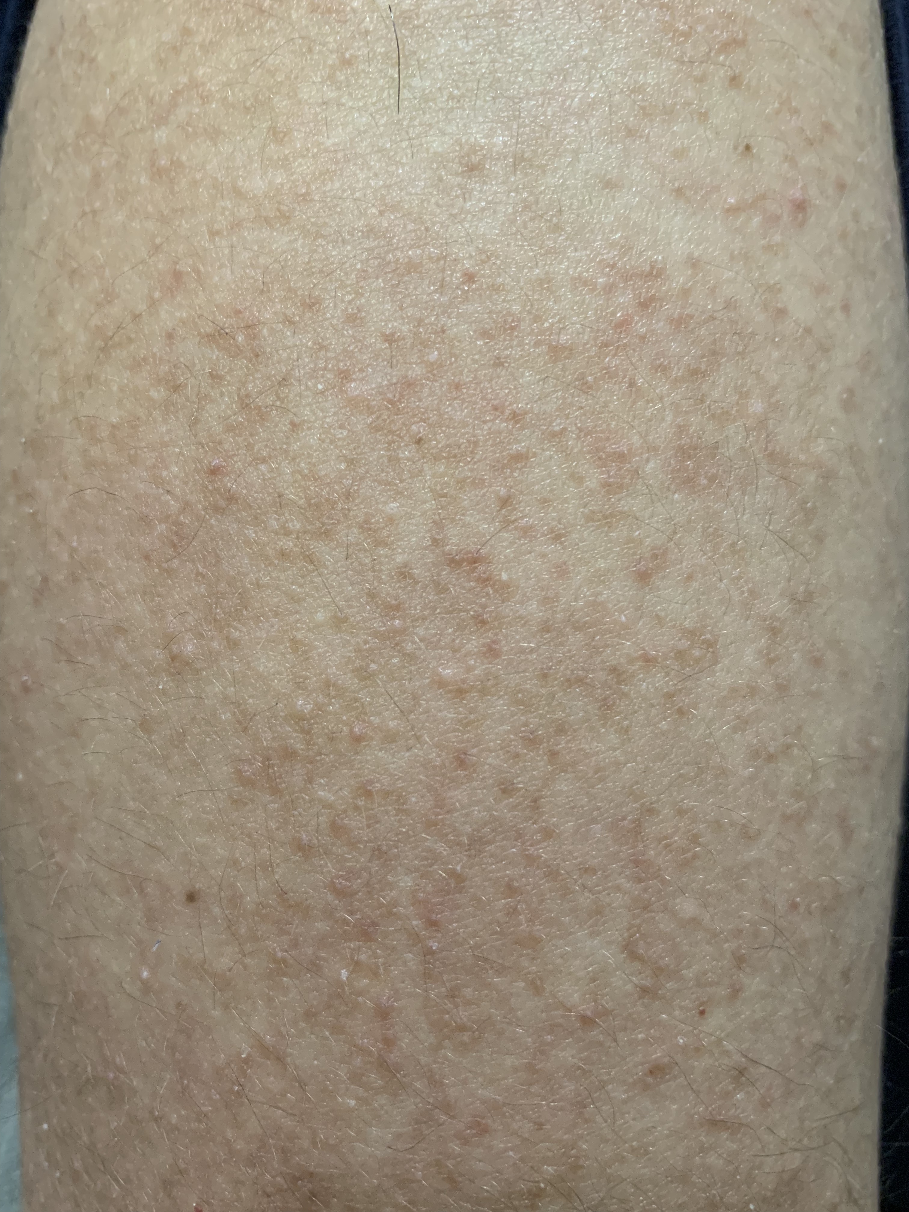 Queratosis Pilar Granitos En Los Brazos Dra Anna Estape