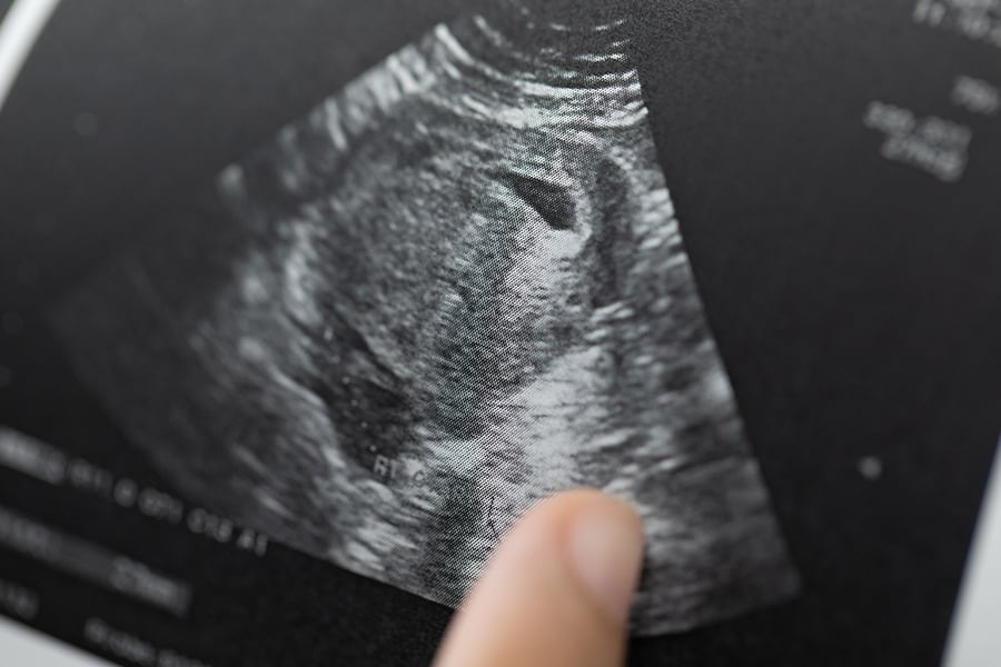 How to Spot a Fake Ultrasound Baby Maybe