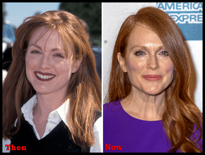 Julianne Moore Plastic Surgery Botox, Facelift Before After Photos