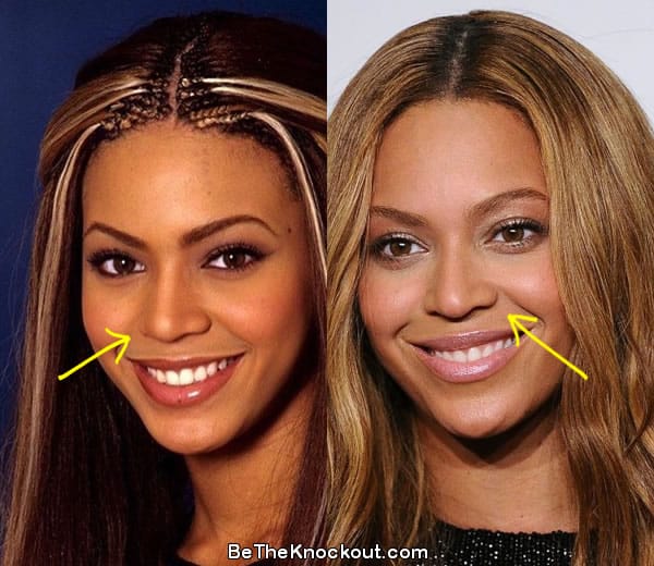 Beyonce Plastic Surgery Comparison Photos