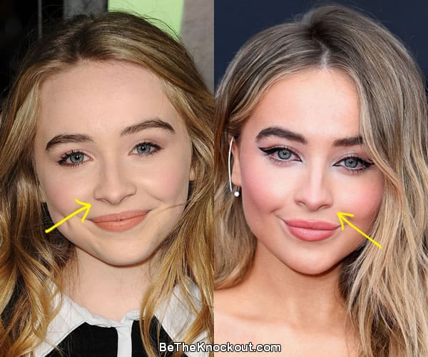 Sabrina Carpenter Plastic Surgery Comparison Photos