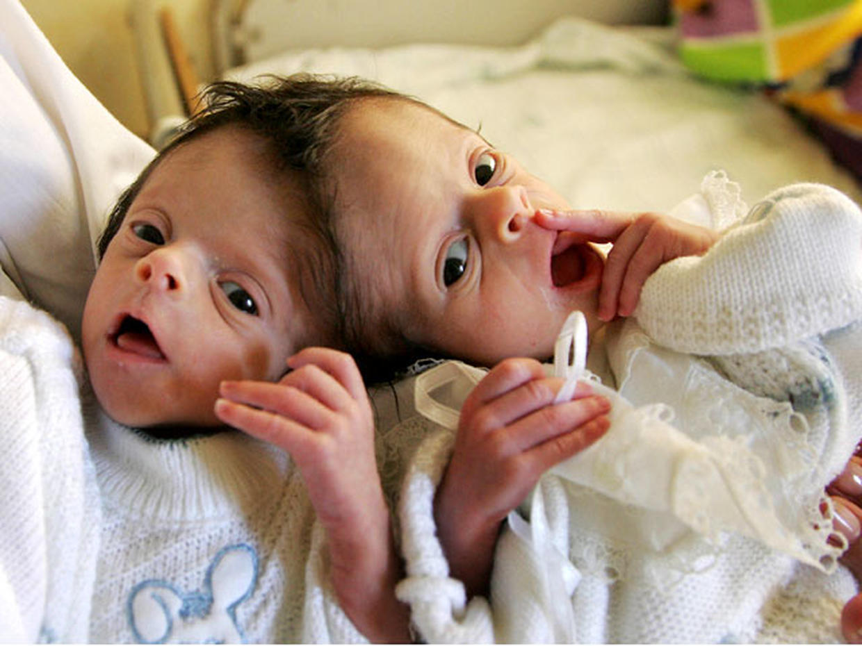 Conjoined twins 40 amazing photos (GRAPHIC IMAGES) Photo 26