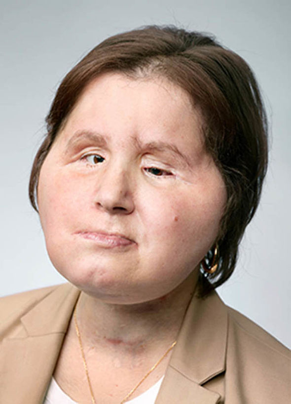 Who is Katie Stubblefield What did she look like before face