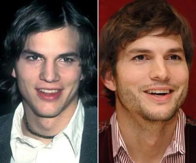 Ashton Kutcher Nose Job Plastic Surgery Before and After Celebie