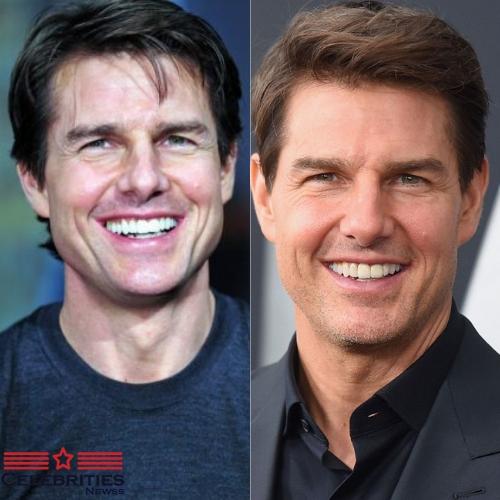 Top 21 Celebrities Before and After Veneers And Cosmetic Dentistry