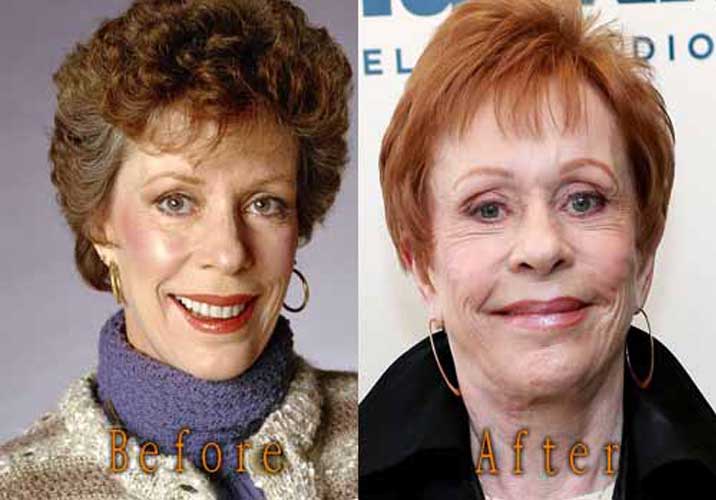 Carol Plastic Surgery Facelift, Botox Before and After Photos