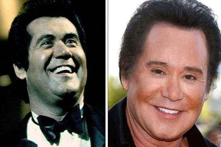 Wayne Newton Plastic Surgery Facelift, Botox, Eyelid Surgery