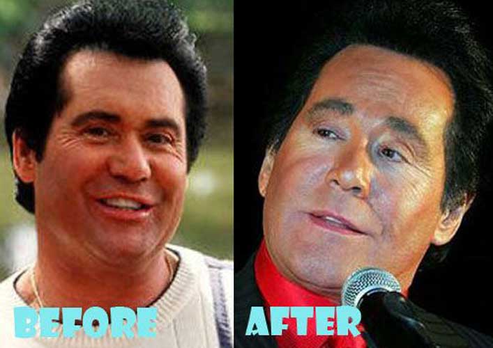 Wayne Newton Plastic Surgery Facelift, Botox, Eyelid Surgery