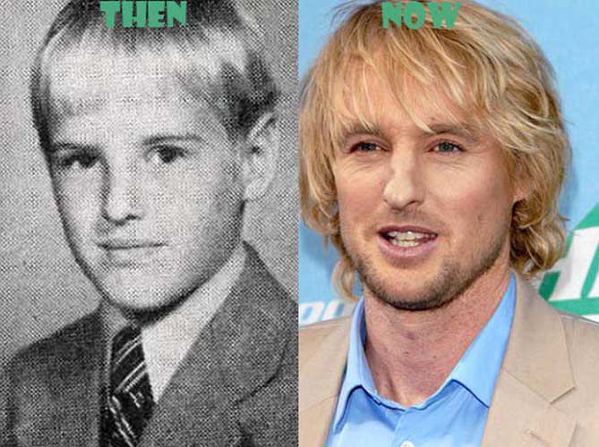 Owen Wilson Nose Job Plastic Surgery and Rhinoplasty