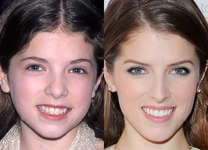 Anna Kendrick Plastic Surgery Boobs, Nose job and Teeth